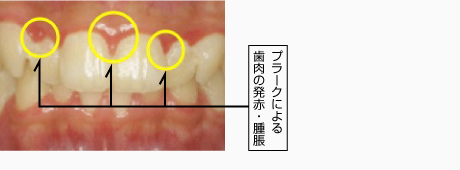 軽度歯周炎（歯肉炎）の画像