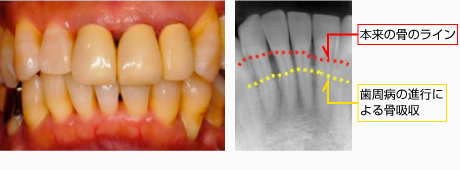 中等度歯周炎の画像