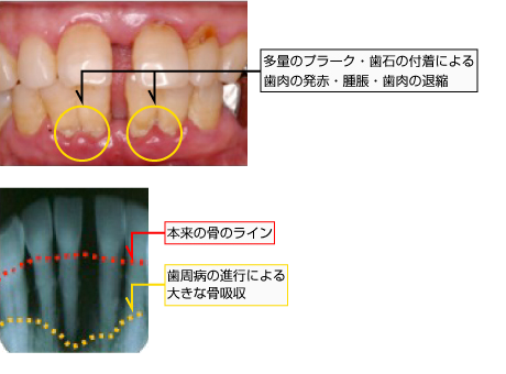 中等度歯周炎の症例画像1