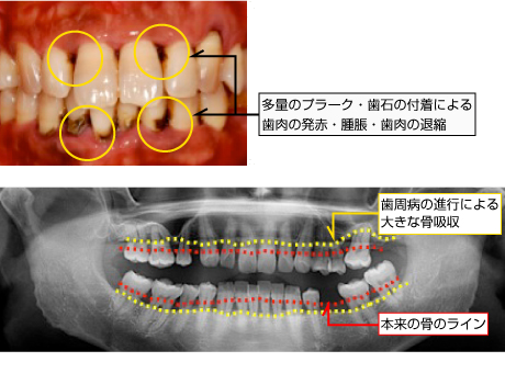 中等度歯周炎の症例画像2